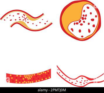 vector of cholesterol plaque illustratrion design Stock Vector