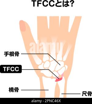 About TFCC  Vector illustration Stock Vector