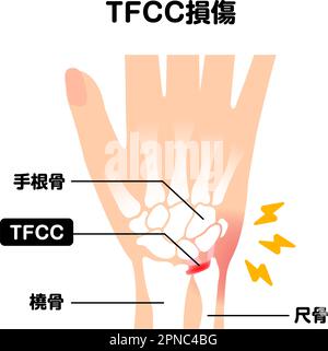 About TFCC injury. Vector illustration Stock Vector