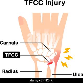 About TFCC injury. Vector illustration Stock Vector