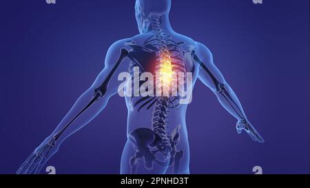 Animation of a painful human spine Stock Photo - Alamy