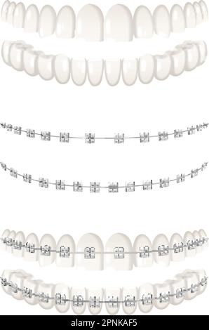 Teeth dental braces realistic icons set isolated vector illustration Stock Vector