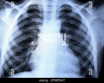 Close-up chest x-ray. Chest x-ray for the diagnosis of lung diseases. X-ray of organs mid adult men, medical examination Stock Photo
