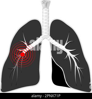 Lungs disease. Black lungs with bronchi and red mark on white background. Human Respiratory system. Vector illustration Stock Vector