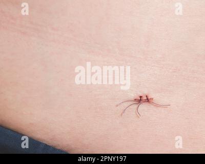 Suture on the skin of the abdomen, close up. Surgical aid for wound closing and healing, copy space Stock Photo