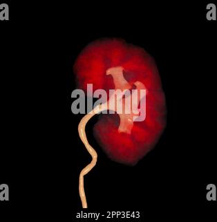 CTA Renal artery   showing kidney 3D rendering image. Stock Photo