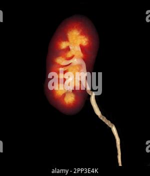 CTA Renal artery   showing kidney 3D rendering image. Stock Photo