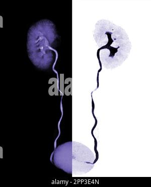 CTA Renal artery  3D rendering image  showing both kidney, Ureter and bladder . Stock Photo