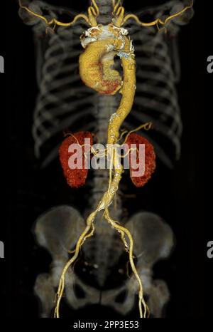 CTA whole aorta 3D rendering. Stock Photo