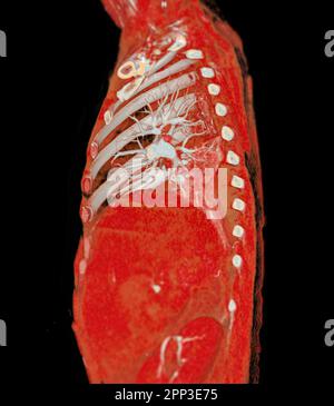 CTA pulmonary arteries 3D rendering showing branch of pulmonary artery Stock Photo