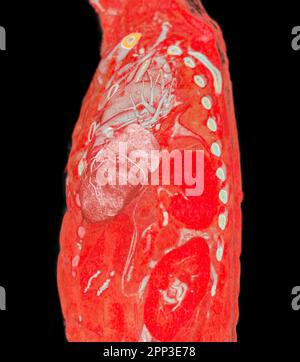 CTA pulmonary arteries 3D rendering showing branch of pulmonary artery Stock Photo