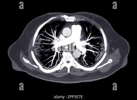 CTA pulmonary arteries 3D rendering showing branch of pulmonary artery Stock Photo
