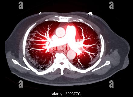 CTA pulmonary arteries 3D rendering showing branch of pulmonary artery Stock Photo