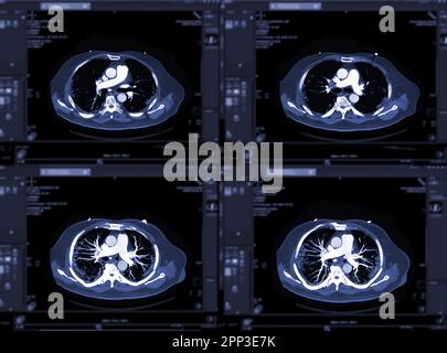 CTA pulmonary arteries 3D rendering showing branch of pulmonary artery Stock Photo