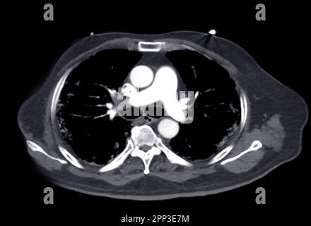 CTA pulmonary arteries 3D rendering showing branch of pulmonary artery Stock Photo