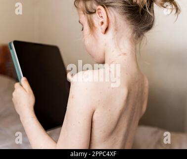 Little girl sitting with her back to camera and looking at tablet. Chickenpox, varicella virus or vesicular rash on child's body and face. Kid with re Stock Photo