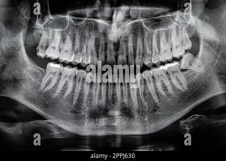 Orthopantomography, OPG X-ray DR digital wisdom teeth. panoramic film x ray dental Stock Photo