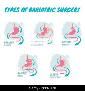 Types of bariatric surgery, it is process for the digestive system in stomach, A new types of bariatric surgery Stock Vector