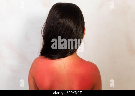 Back of black haired girl with severe red burns after spending time in sun, gray background. Child suffer from pain on inflamed areas of burned skin Stock Photo