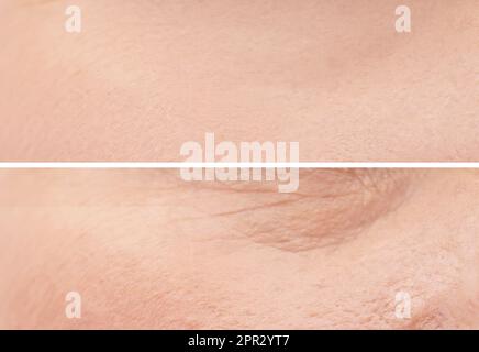 Collage with photos of dry and moisturized skin texture Stock Photo