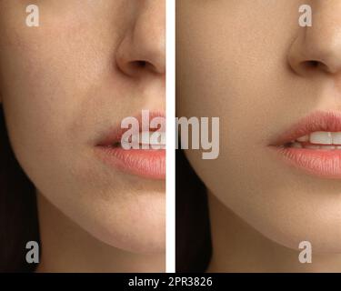 Collage with photos of woman having dry skin problem before and after moisturizing, closeup Stock Photo