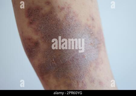 red rash girl Skin disease caused by allergies to drugs, food ...