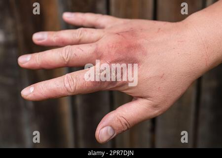 First degree skin burn. Hand burns, wounds. Hot boiling water acts on the skin. Fresh burn. Stock Photo