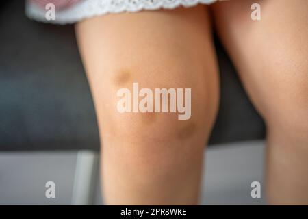 Close up of stains bruise wound on legs of little girl. Extravasation blue, purple on skin. Active childhood concept Stock Photo