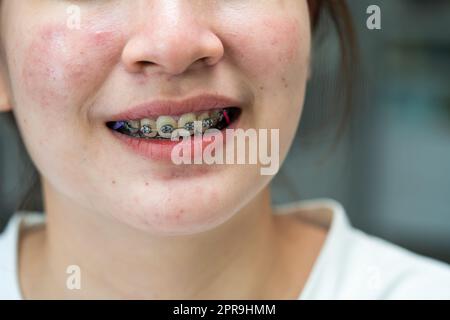 Braces in teenage girl mouth to treat and beauty for increase confidence and good personality. Stock Photo