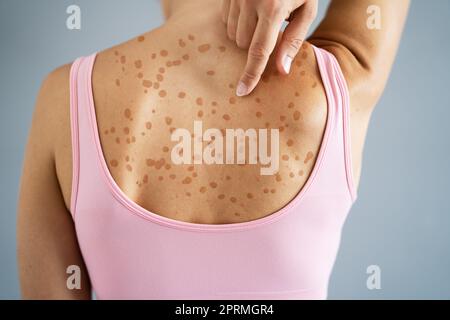 Woman Body Skin Rash Treatment Before After Stock Photo - Alamy