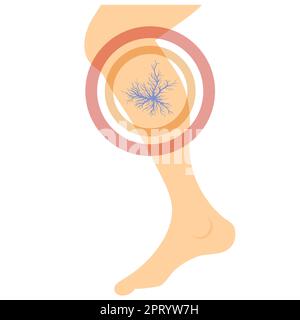 Spider Veins on Skin. Human Vessel, Health Arteries. Red Blood. Varicose. Stock Vector