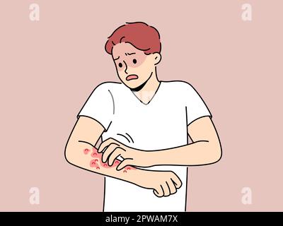 Man scratching skin. Guy scratch sensitive skins on itchy hand, scabies ...