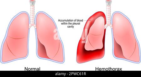 Hemothorax. Healthy human lungs and red lungs after accumulation of blood within the pleural cavity. Chest trauma. pulmonary embolism treatment Stock Vector