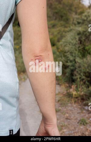Arm of a woman with a skin rash on her elbows taking a walk in the countryside as therapy for stress Stock Photo