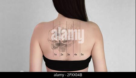 Laser Tattoo Removal On Woman's Back Against White Background Stock Photo