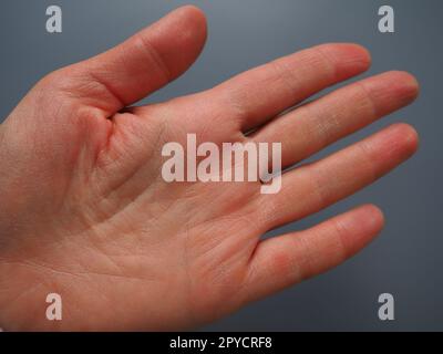 Female hand with dry atopic skin. White background. Close-up of the skin on the palm and fingers. Dermatological problems. Fortune telling by the lines on the hand, palmistry Stock Photo