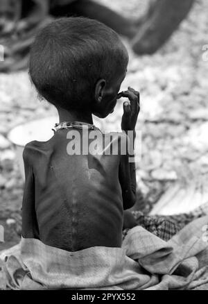 KEN , KENYA : A malnourished girl in a feeding centre in Wajir . 20.06.1992 Stock Photo