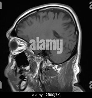 Healthy human brain, MRI scan Stock Photo