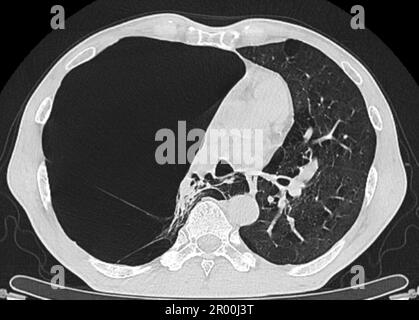 Pulmonary giant bulla, CT scan Stock Photo