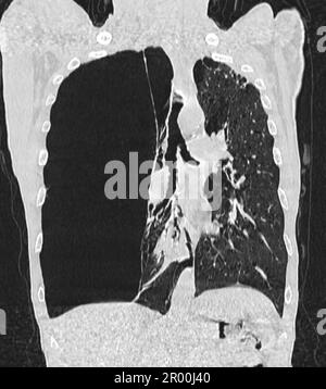 Pulmonary giant bulla, CT scan Stock Photo