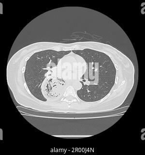 Achalasia of the oesophagus, CT scan Stock Photo - Alamy