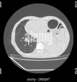 Hiatus hernia, CT scan Stock Photo