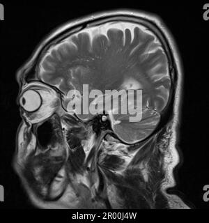 Healthy human brain, MRI scan Stock Photo