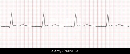 Black heartbeat diagram on red graph paper. Electrocardiogram chart ...