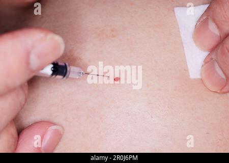 Close up of needle withdrawn from injection site leaving a drop of ...