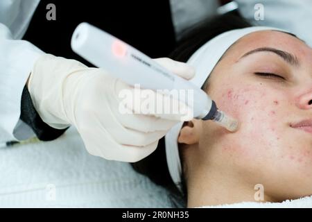 Closeup view of woman having microneedling procedure applied on her face Stock Photo