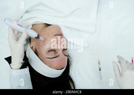 Top view of female patient having microneedling procedure applied on her face Stock Photo