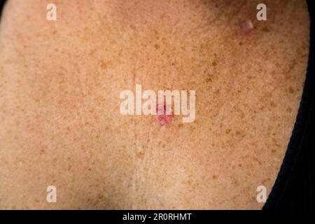 Young 30s caucasian female is anxious aftern superficial basal cell carcinoma skin cancer diagnosis. Stock Photo