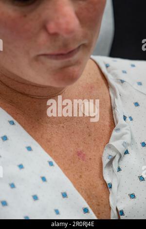 Close up of woman at dermatology appointment for basal cell carcinoma skin cancer procedure. Stock Photo