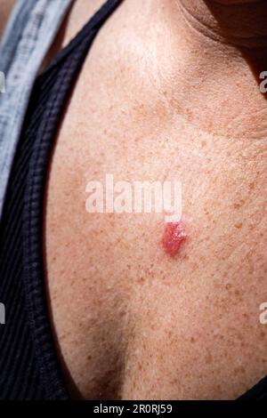 Young female 30s close up of chest prior to applying imiquimod cream medication to basal cell carcinoma. Stock Photo